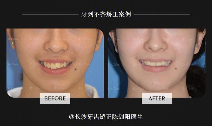 长沙拔门牙矫正牙齿会松动吗？正畸医生说出大实话