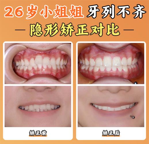 长沙北京舌侧矫正靠谱吗？价格/医院/医生全揭秘