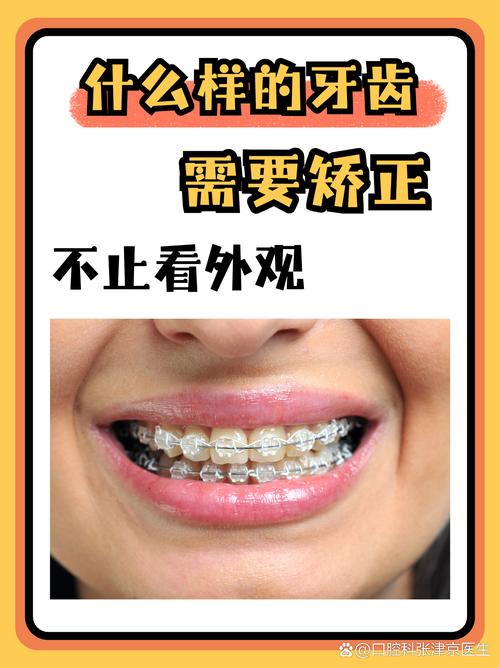 长沙45岁矫正牙齿还来得及吗？过来人分享3年真实经历，成人正畸必看