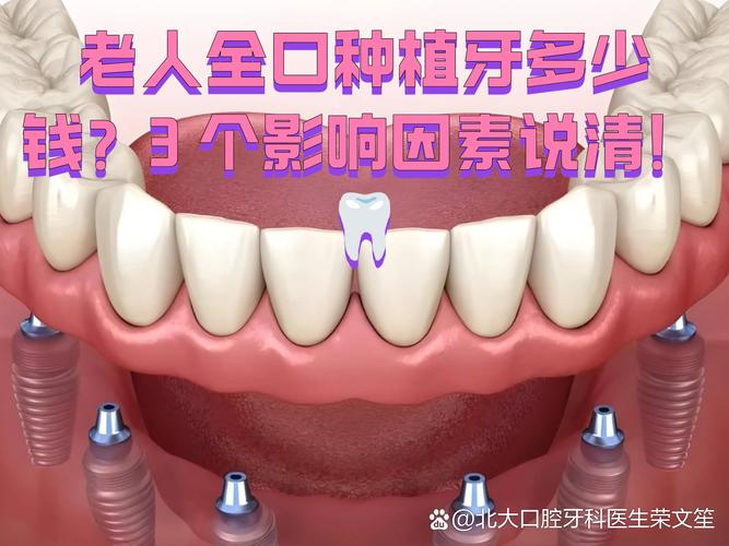 长沙深圳老人全口种牙费用明细 深圳全口种植牙价格参考