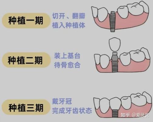 长沙杭州种植牙骨粉贵不贵？要补多少？