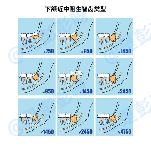长沙杭州口腔医院拔牙要花多少钱？怎么选才不踩坑？