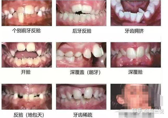 长沙青岛儿童几岁做正畸最好？多少钱？