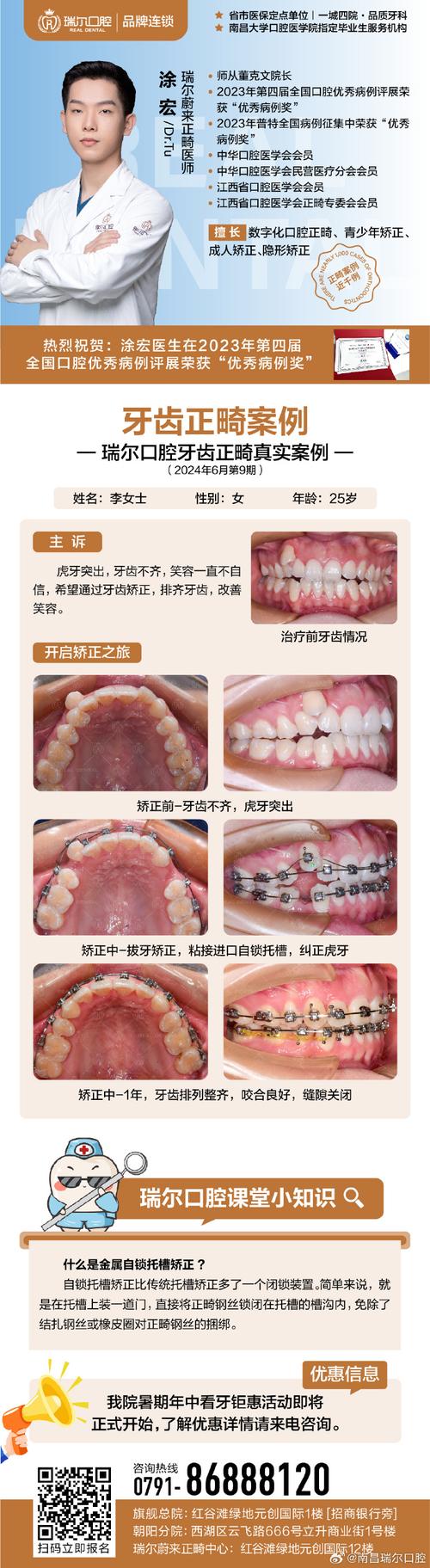 长沙成人龅牙矫正选医院还是诊所？关键看医生资质和案例对比