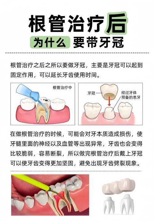 长沙根管治疗补牙到底怎么回事？医生详解步骤和必要性