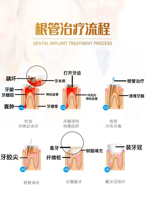 根管治疗补牙_根治疗管补牙要多少钱_根治疗管补牙要多久