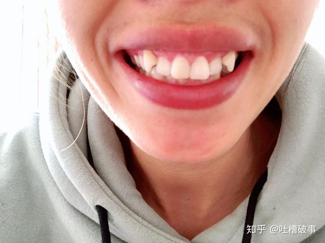 长沙虎牙想要快速矫正?攻略这里给你讲明白