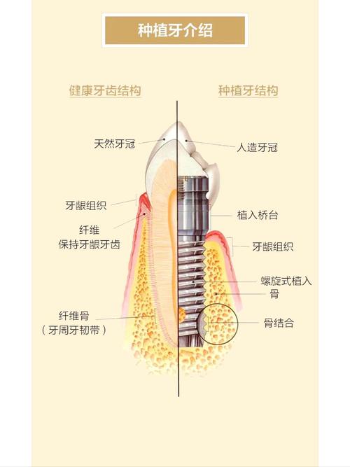 长沙什么叫种植牙齿 一篇讲清原理过程