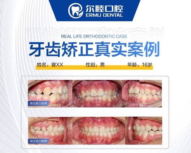 深圳儿童正畸_深圳儿童正畸套餐哪家划算_深圳儿童牙齿矫正