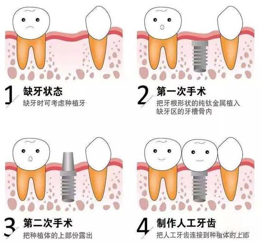 长沙上海种植牙全过程揭秘：从挂号到戴牙多久？