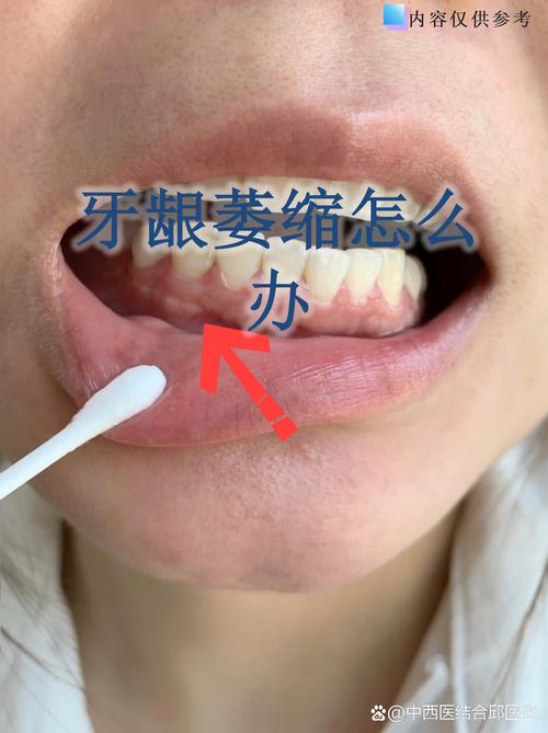 长沙缺牙不补的严重后果:邻牙倾斜松动,对牙伸长,牙槽骨萎缩