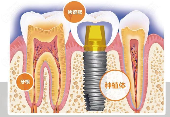 长沙赤峰种牙费用详解：从预算到效果，给您的实惠指南