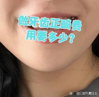 长沙深圳福田青少年钢丝矫正牙齿要花多少钱