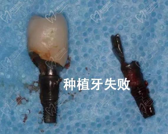 长沙种植牙失败了怎么办?修复费用到底要多少?