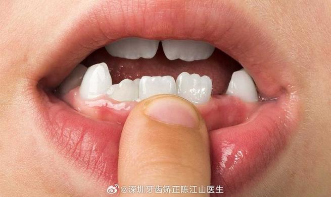 长沙小孩牙齿长成锯齿状，到底严重不严重？