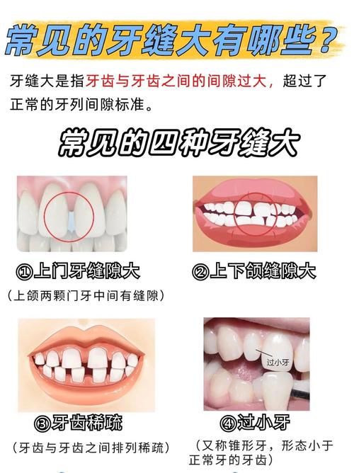 长沙矫正牙齿门牙缝隙变大了？医生告诉你正常吗咋应对