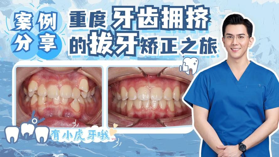 长沙告别“虎牙”尴尬，快速矫正重塑自信笑容