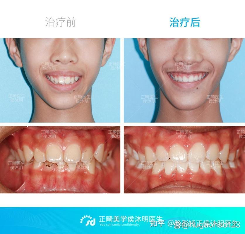 长沙25岁龅牙还能矫正吗？过来人分享真实经历