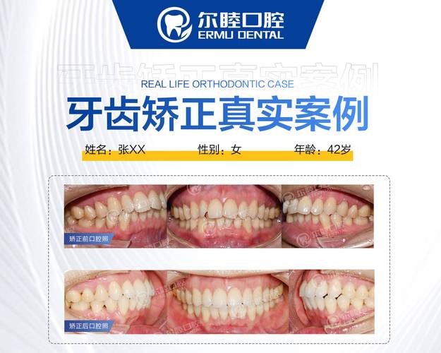 长沙深圳宝安换牙矫正多少钱？最新费用参考来了