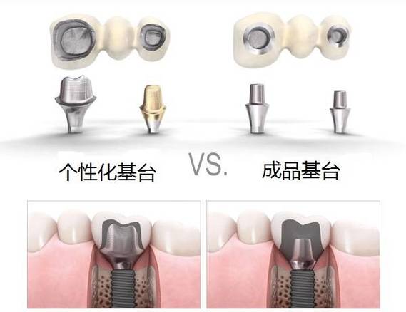 长沙缺牙后选进口还是国产种植体？到底哪个更划算？