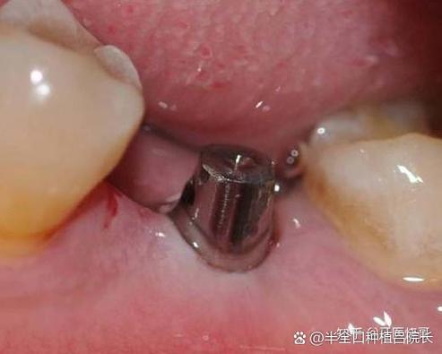 长沙深圳罗湖骨量少做全口种植牙到底要花多少钱