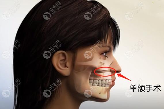 长沙深圳成人骨性龅牙矫正到底要花多少钱？