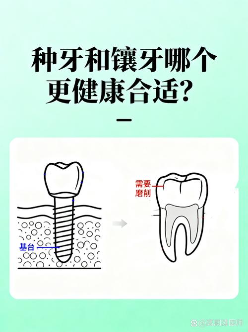 长沙25岁镶牙还是种牙好?别磨坏好牙,年轻人种牙是长期投资