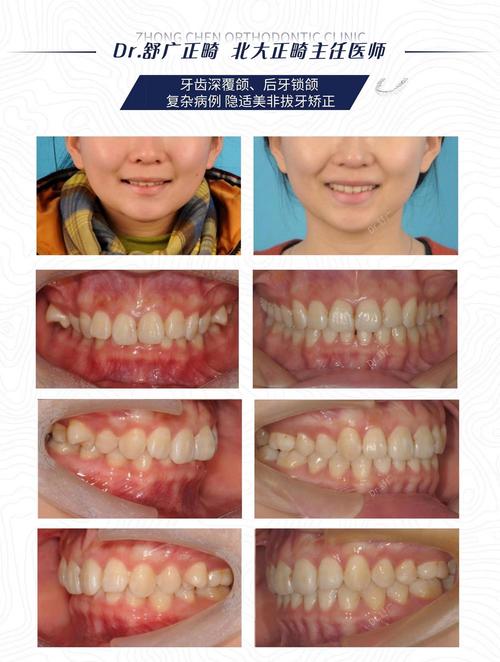 长沙30岁后矫正深覆合？成人正畸完全可行