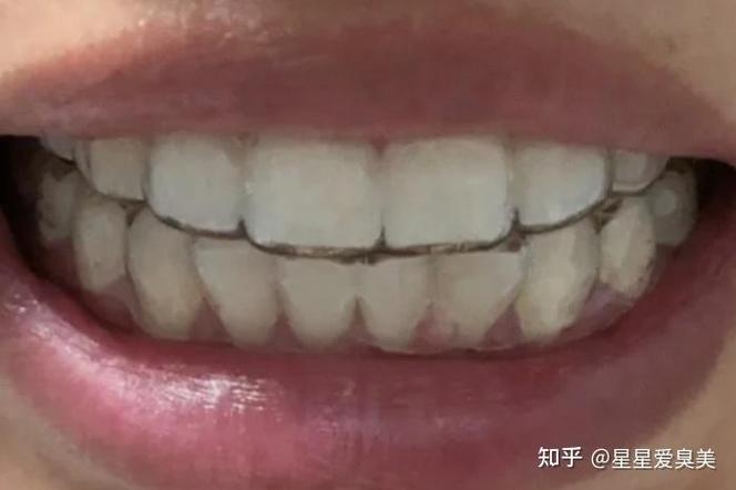 长沙牙齿矫正30岁开始晚吗？过来人分享真实经历与经验