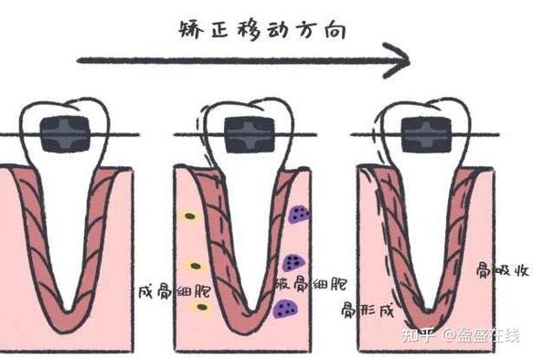 长沙23岁做牙齿矫正晚不晚？过来人分享真实经历