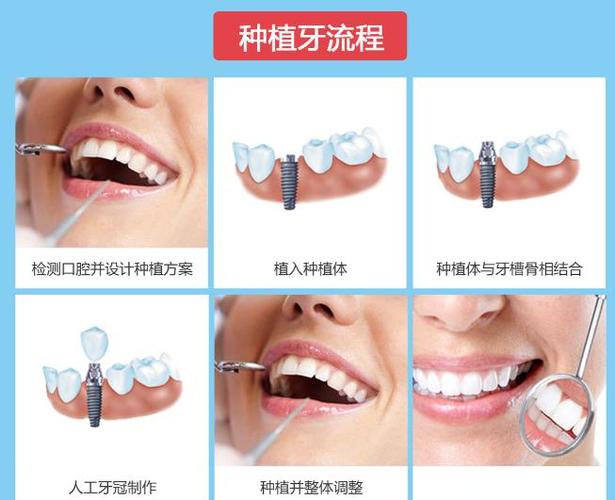 长沙深圳罗湖骨量不足全口种牙多少钱？费用明细来了