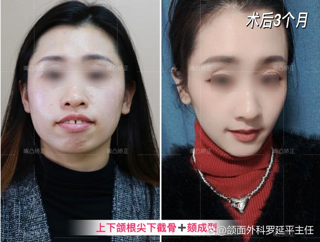 长沙凸嘴矫正真能靠整牙改变？来看真实效果