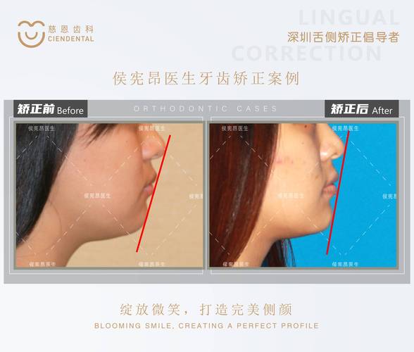 长沙为什么24岁做牙齿矫正效果更好