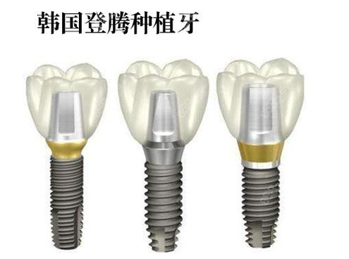 长沙株洲种牙哪家强？公立医院性价比之选