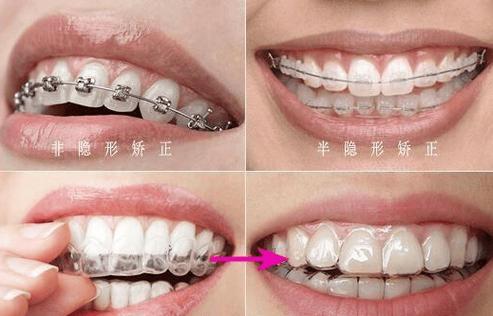 长沙30多岁还能矫正牙齿吗?过来人真实经验分享