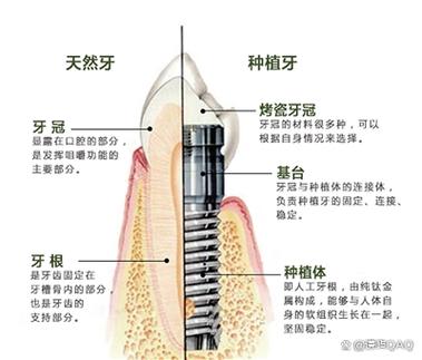 长沙深圳缺牙修复：镶牙与种植牙到底哪个更省钱？