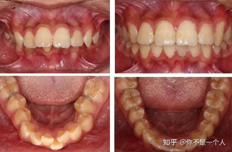 长沙27岁整牙晚不晚？揭秘成年正畸的真实效果与风险