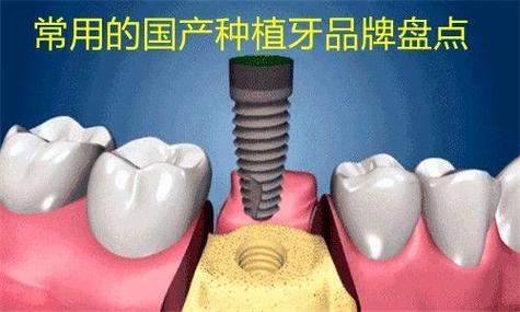 长沙深圳百康特种牙多少钱一颗？真实价格内幕揭秘