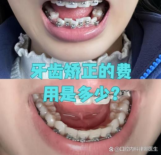 长沙宿迁牙齿矫正一般要花多少钱？