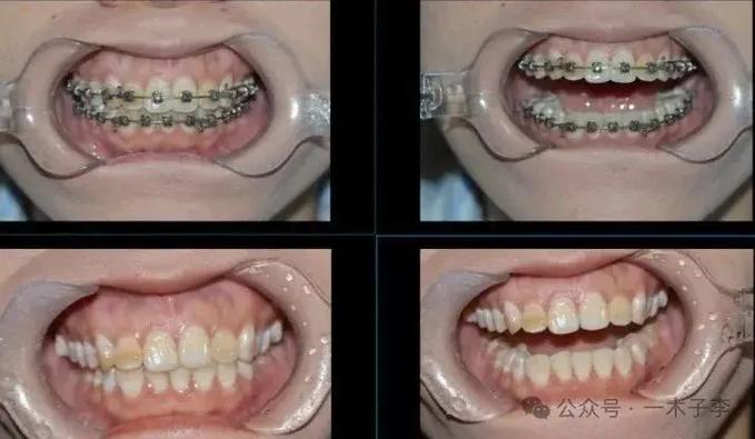 长沙30岁矫正牙齿有什么危害?把坑说透了再决定