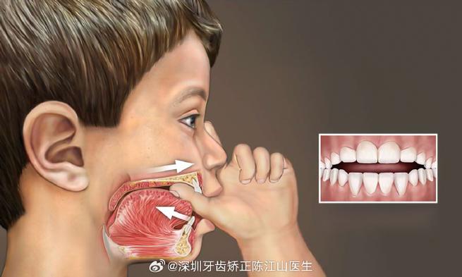 长沙深圳孩子地包天几岁治最好？牙医揭秘黄金期