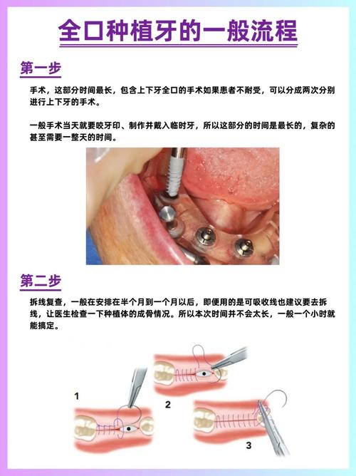 种牙是真牙吗还是假牙_什么是种牙如何种_种牙是怎么种的
