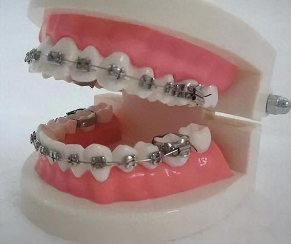 长沙35岁矫正牙齿还来得及吗？真实体验告诉你