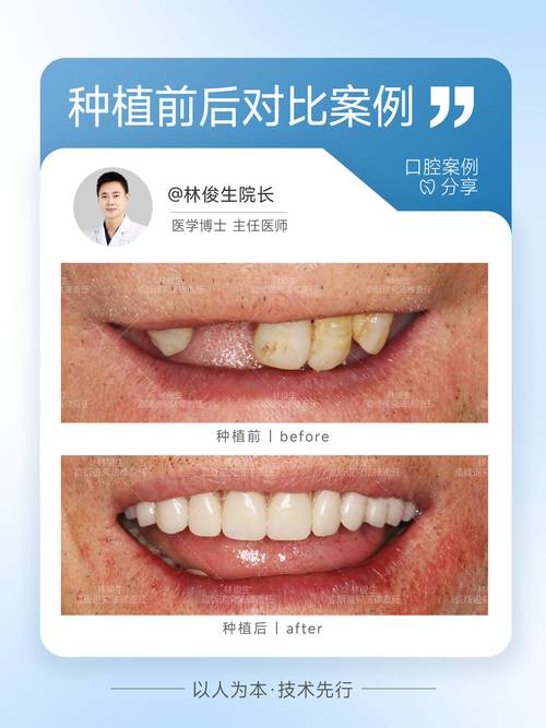 深圳龙华种牙价格_龙华种植牙哪里最好_龙华清湖种植牙价格