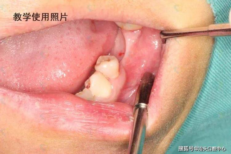 长沙没有牙骨也能种牙？医生说实话