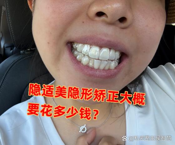 长沙深圳龙岗隐适美牙套到底多少钱？2026年最新价格大揭秘