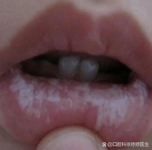 长沙儿童口腔有白色黏膜到底严不严重