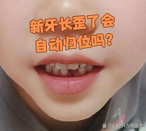 长沙六岁孩子门牙长歪先别慌 看这几种矫正办法