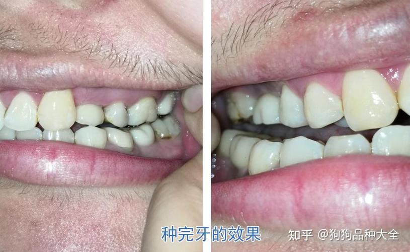 长沙赤峰种植牙哪里好 公立三甲靠谱推荐