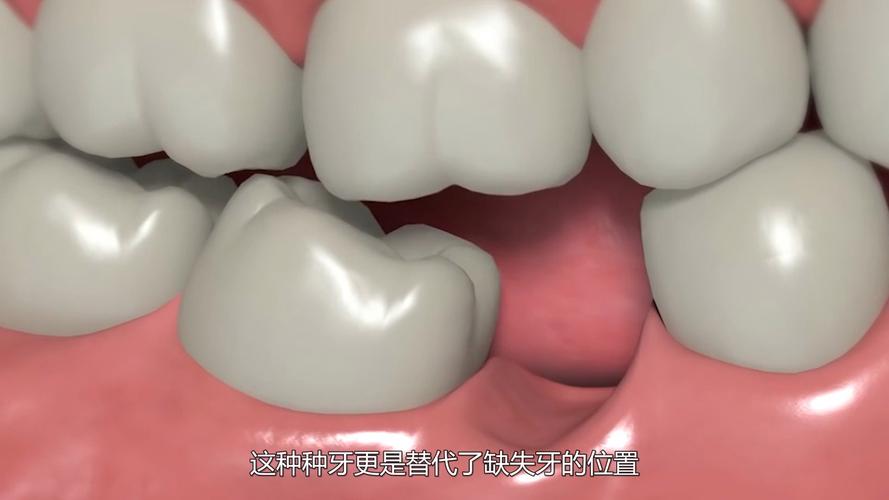 长沙种牙到底疼不疼？一篇说清楚植牙真相
